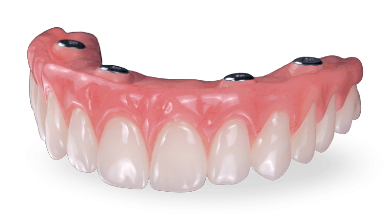 FULL ARCH IMPLANT SUPPORTED PROSTHESIS